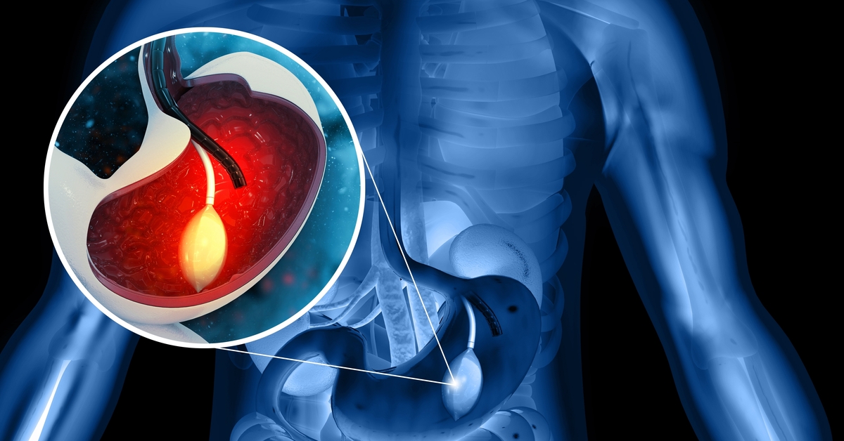 Yutulabilir mide balonları yasaklandı